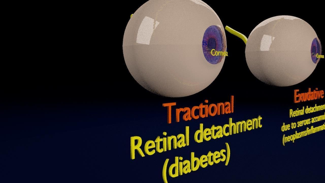 Retinal detachment types eye 3D model_9