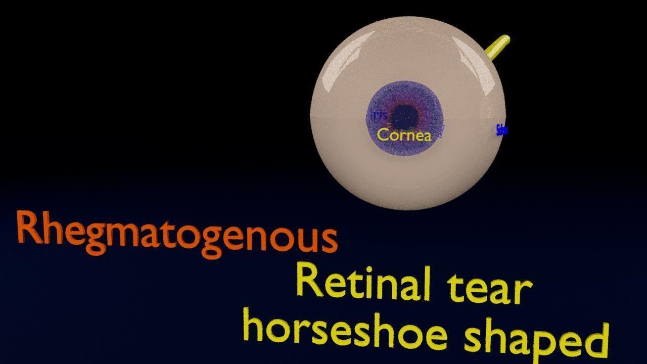Retinal detachment types eye 3D model_6