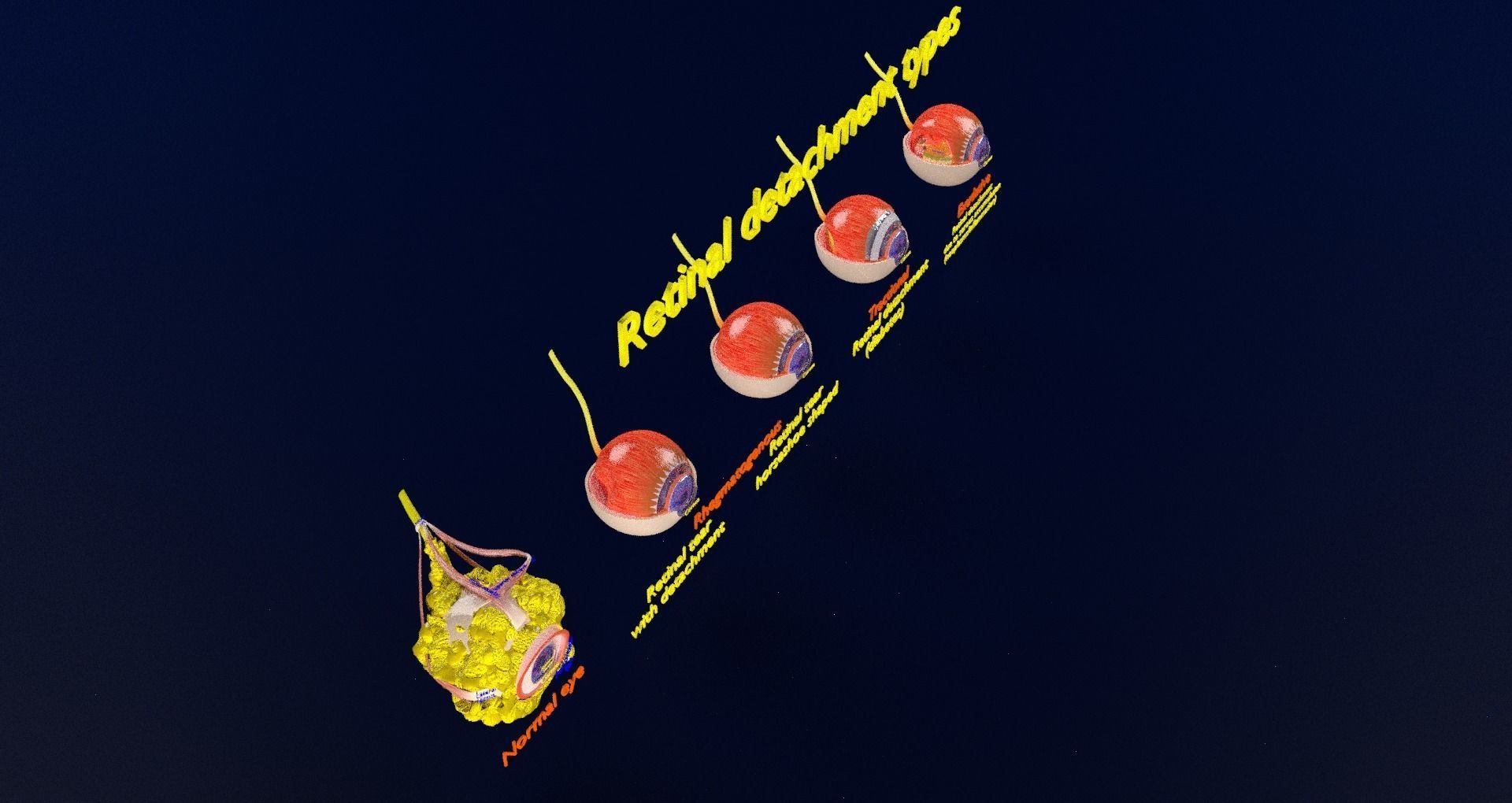Retinal detachment types eye 3D model_41