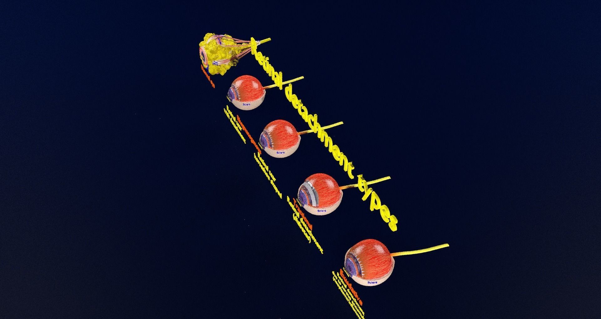 Retinal detachment types eye 3D model_87