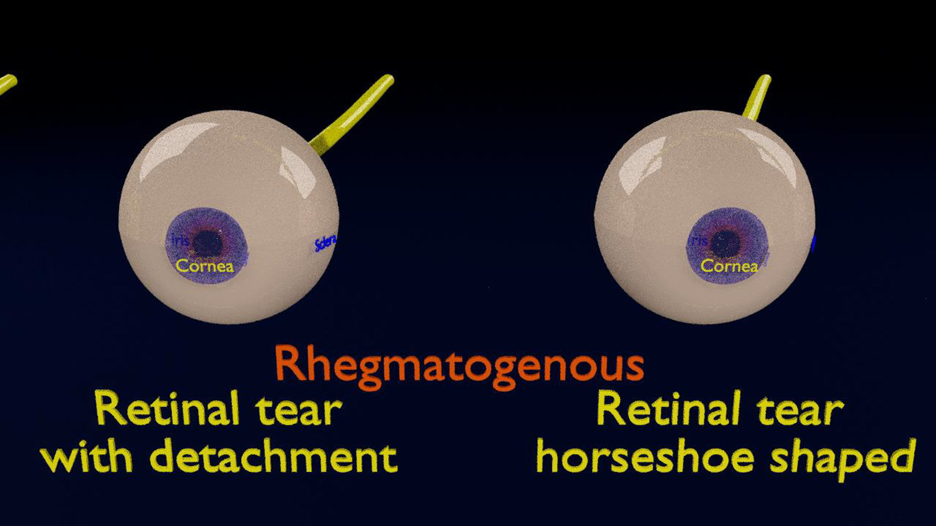 Retinal detachment types eye 3D model_3
