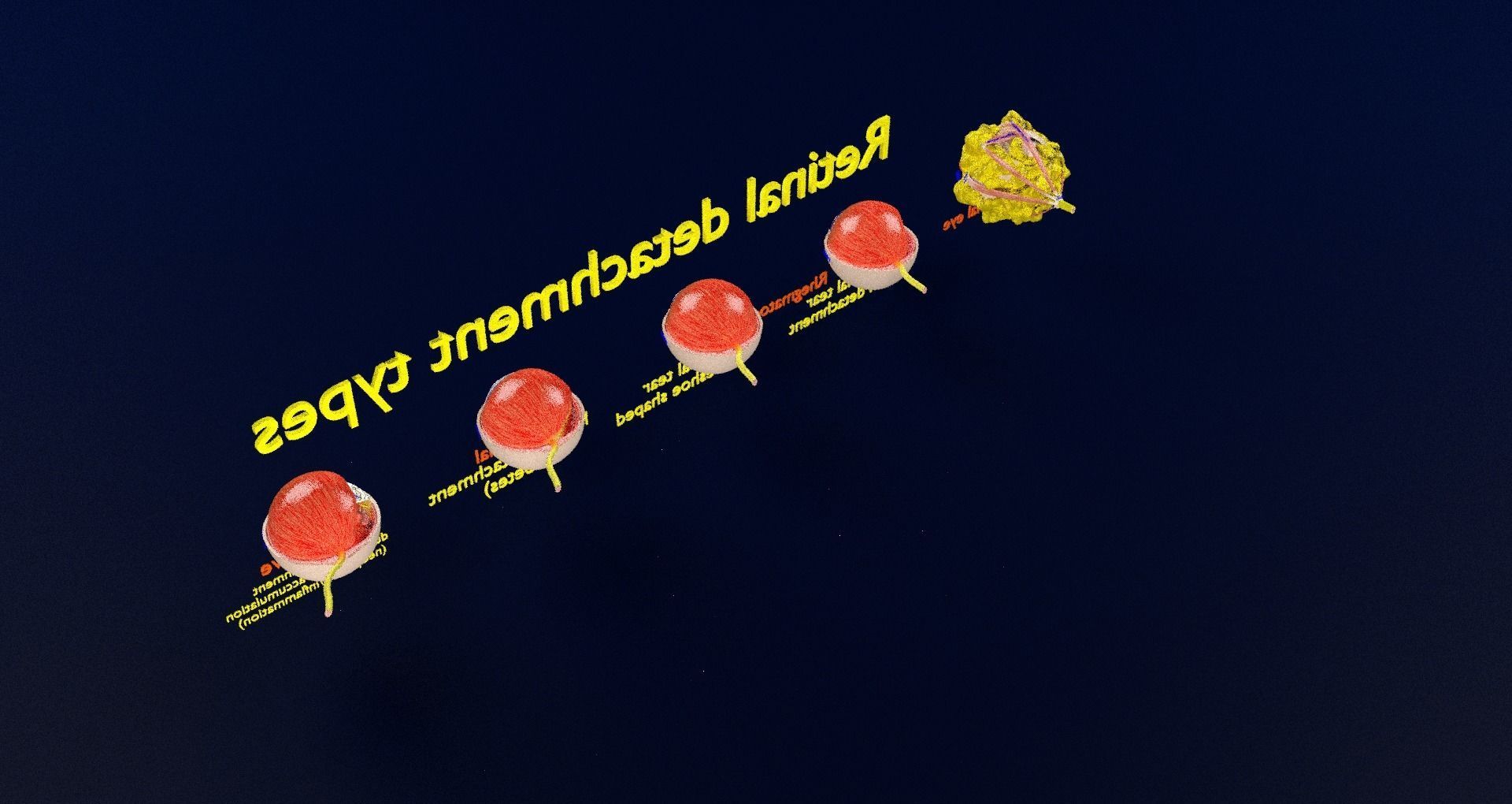 Retinal detachment types eye 3D model_73