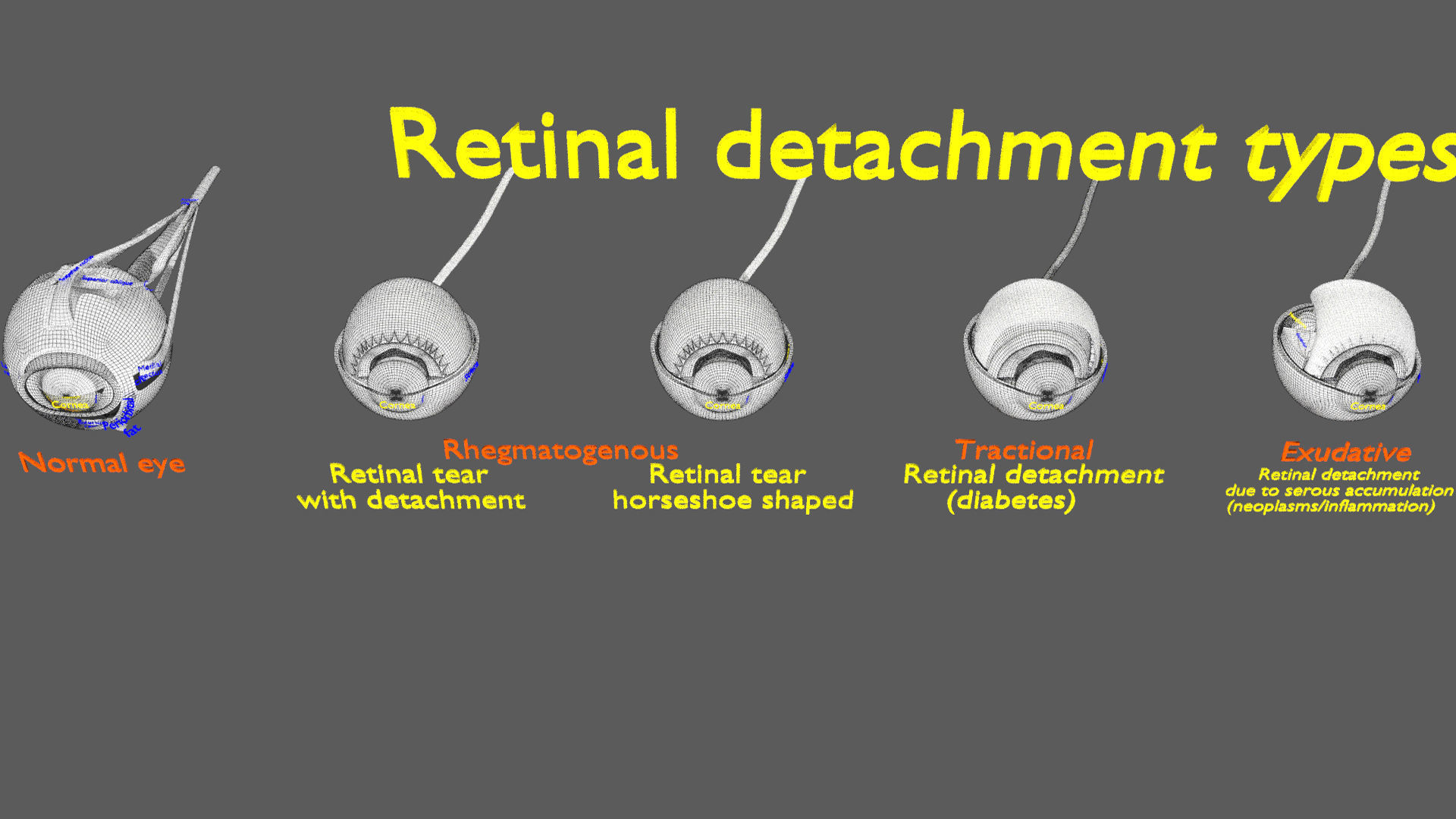 Retinal detachment types eye 3D model_19