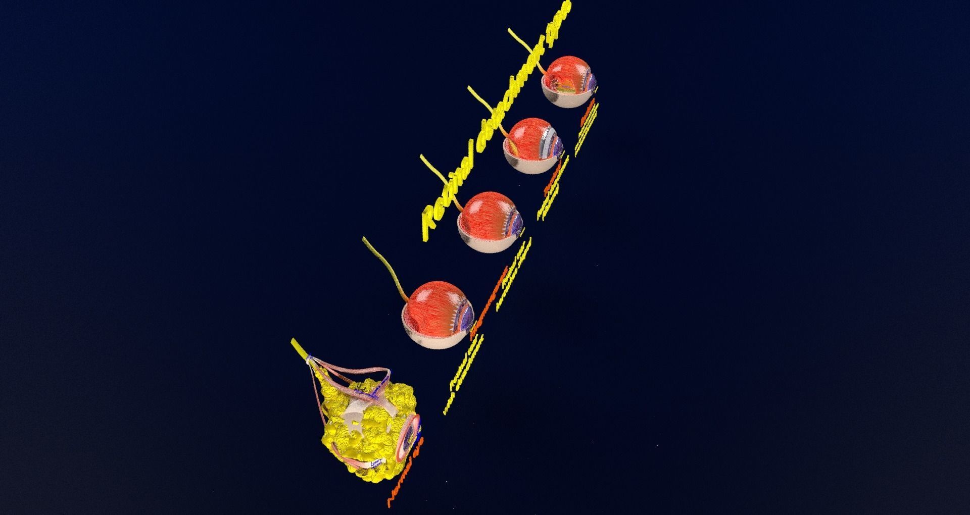 Retinal detachment types eye 3D model_43