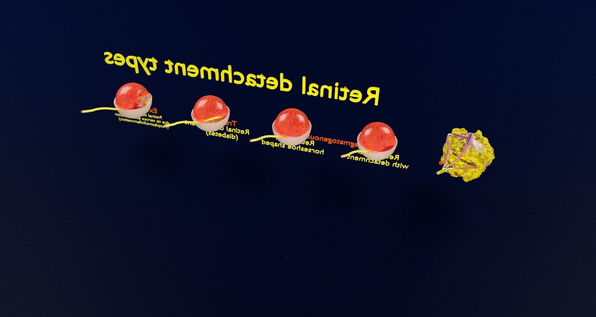 Retinal detachment types eye 3D model_61