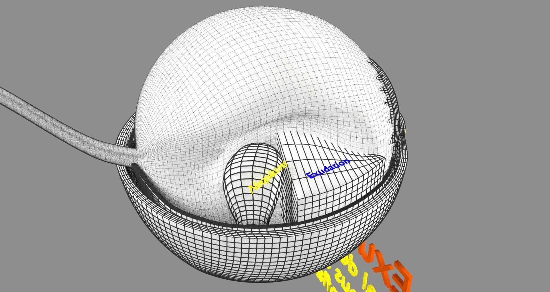 Retinal detachment types eye 3D model_27