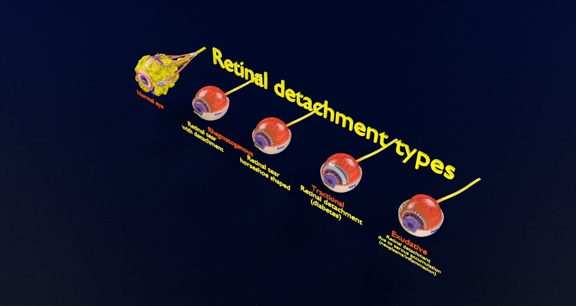 Retinal detachment types eye 3D model_97