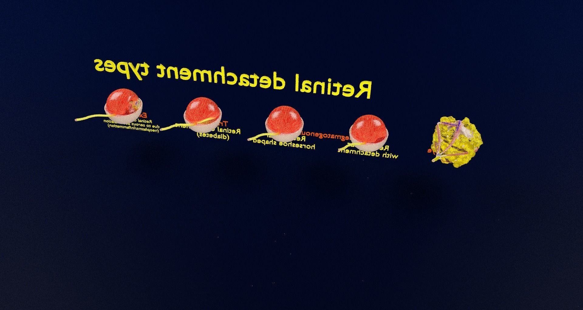 Retinal detachment types eye 3D model_69