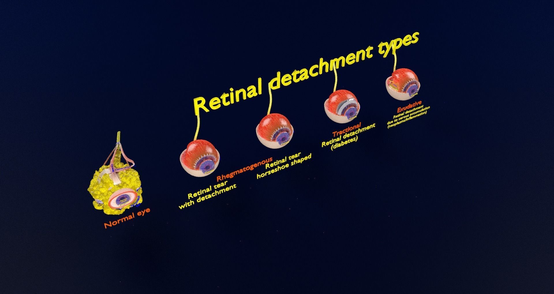Retinal detachment types eye 3D model_31