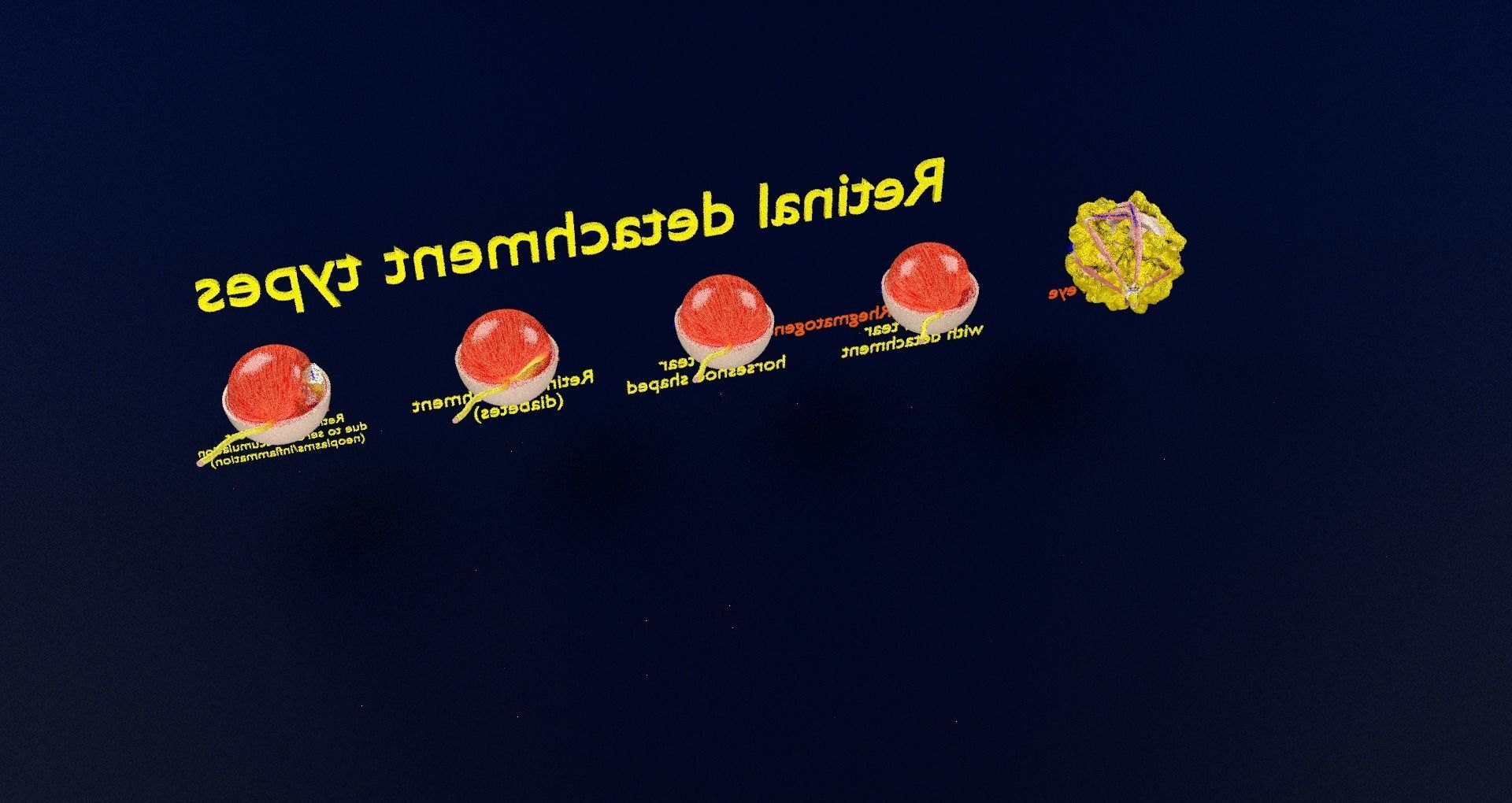 Retinal detachment types eye 3D model_67