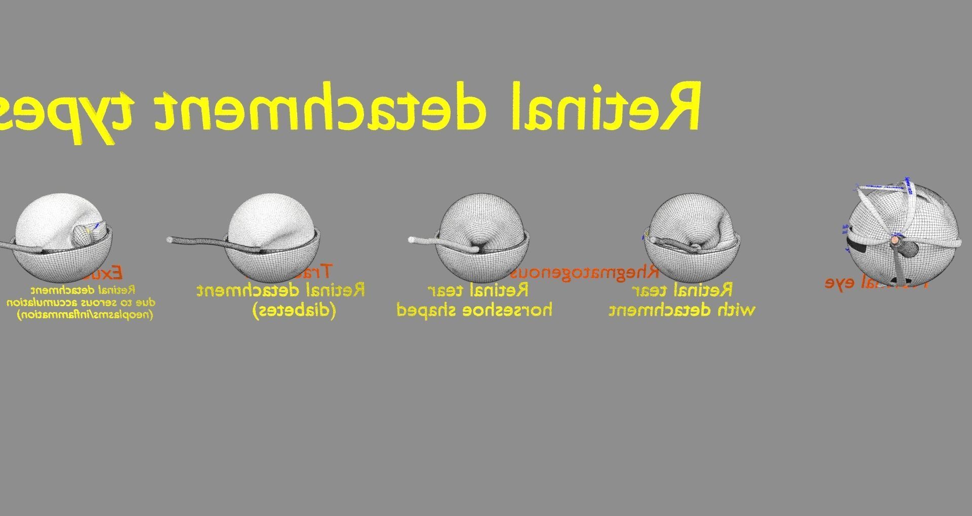Retinal detachment types eye 3D model_28