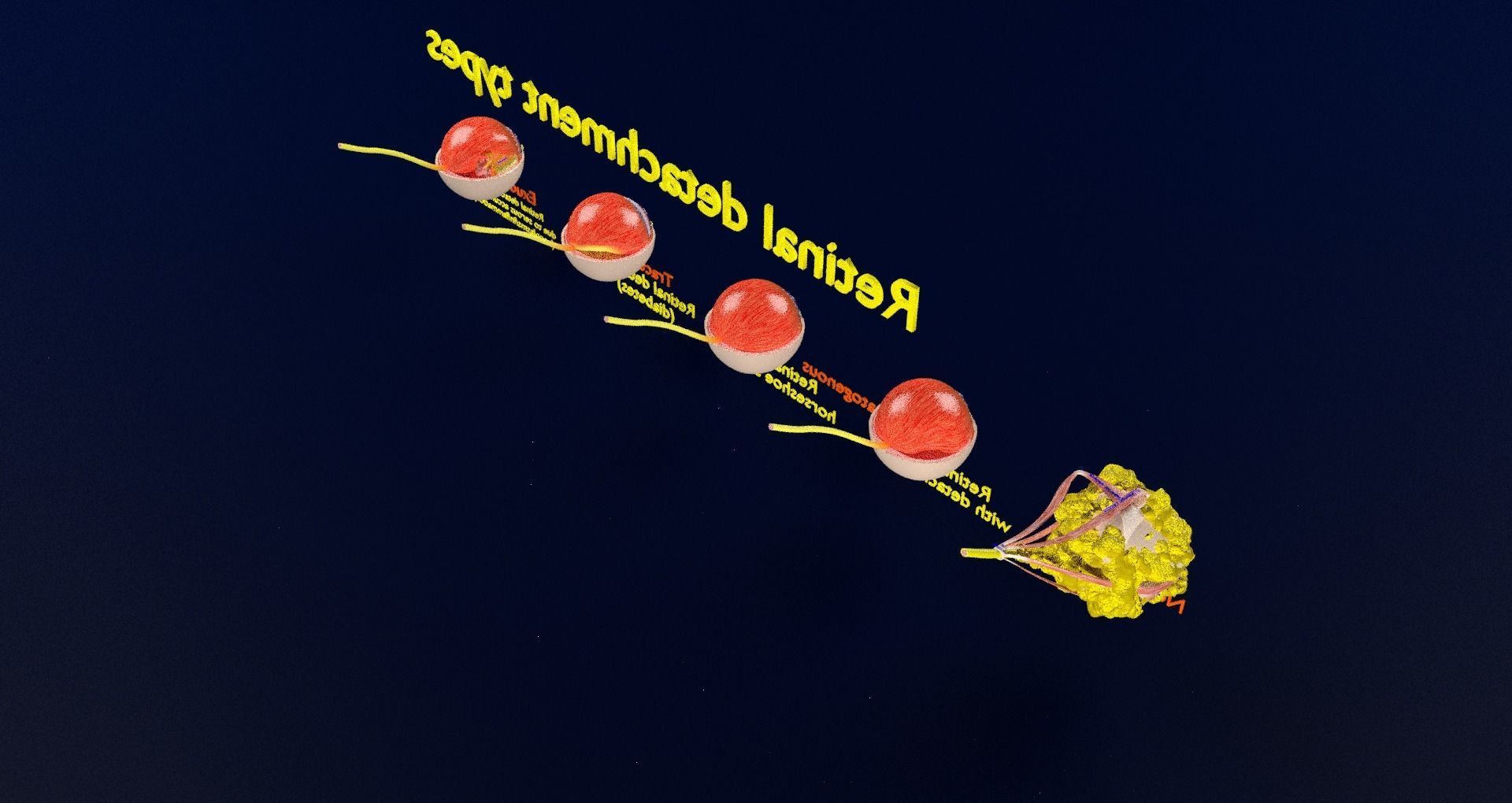 Retinal detachment types eye 3D model_54