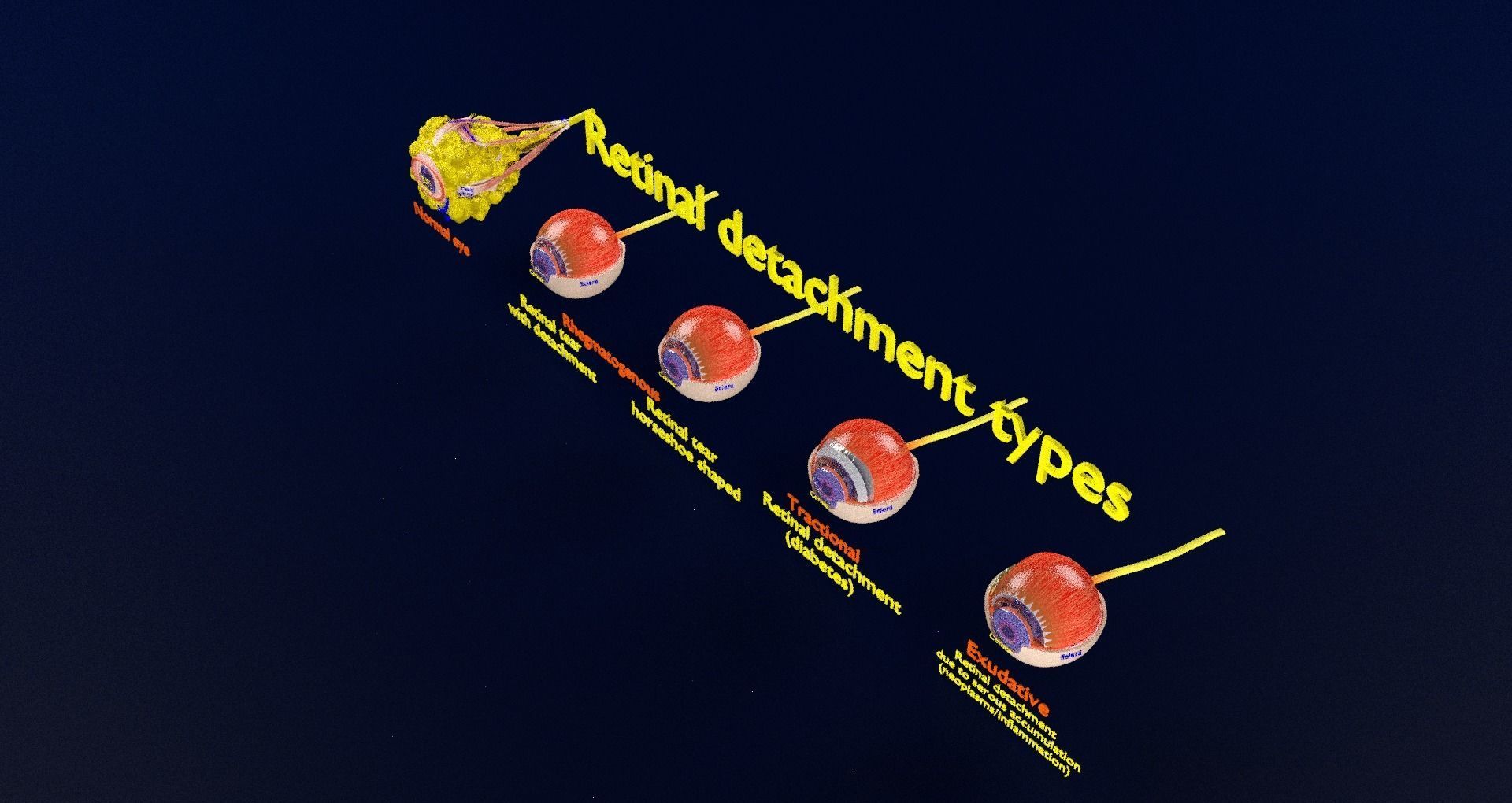 Retinal detachment types eye 3D model_93