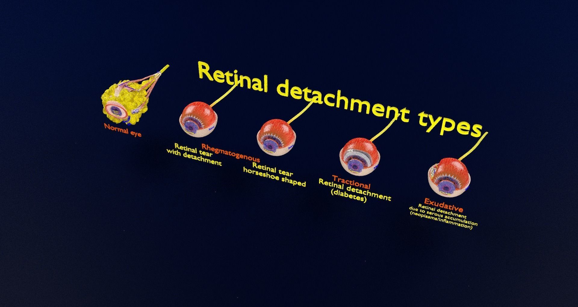 Retinal detachment types eye 3D model_99