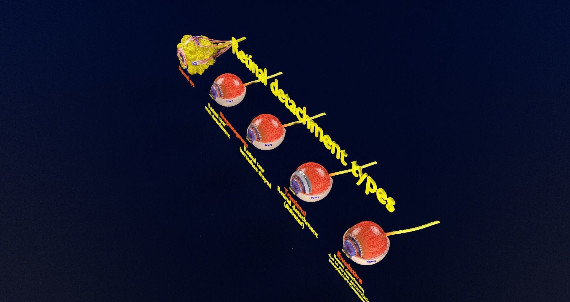 Retinal detachment types eye 3D model_94