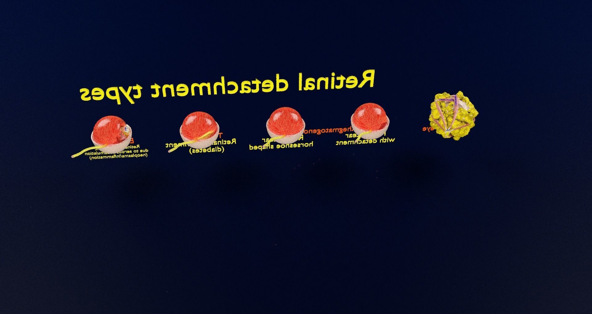 Retinal detachment types eye 3D model_68