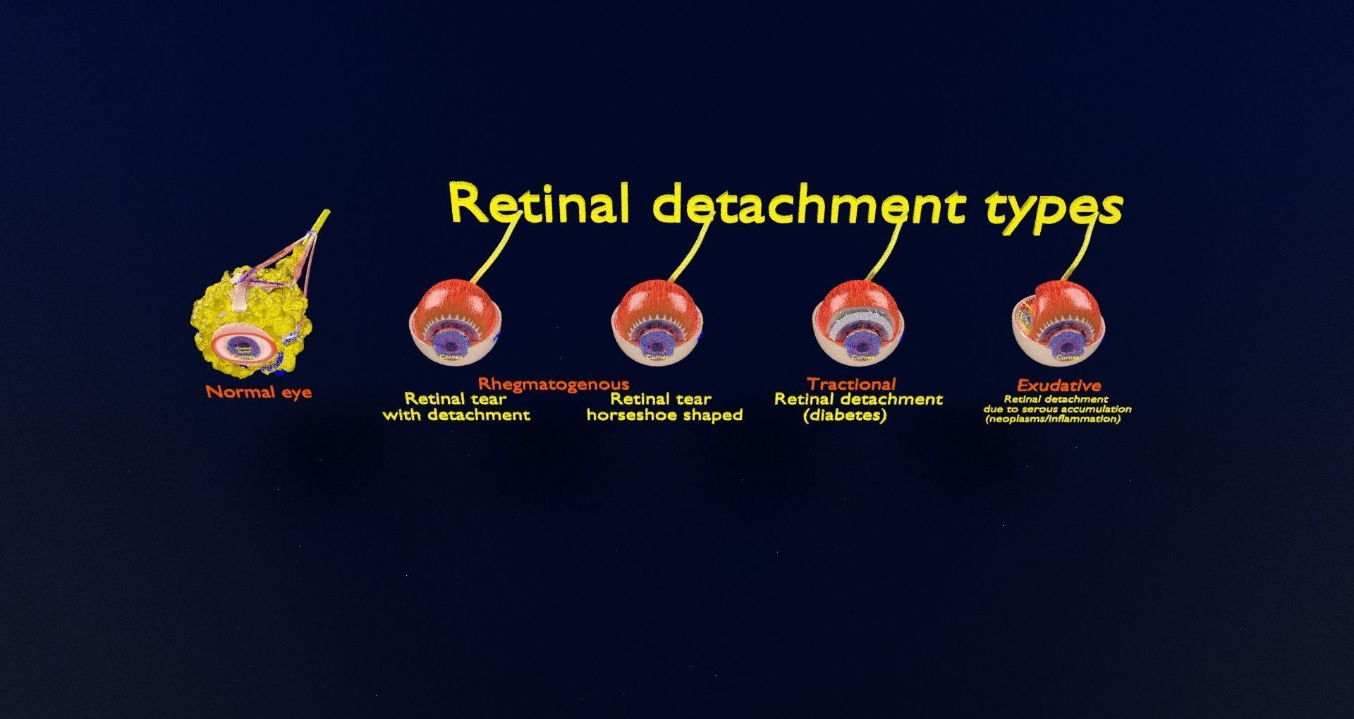 Retinal detachment types eye 3D model_33