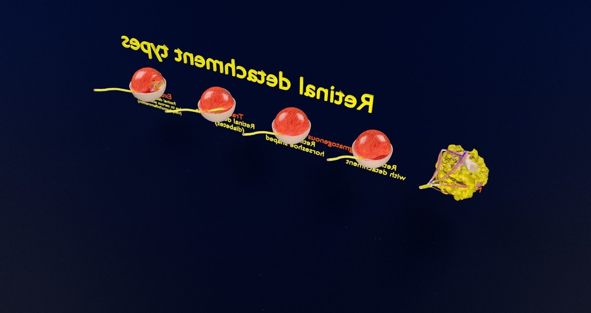 Retinal detachment types eye 3D model_62