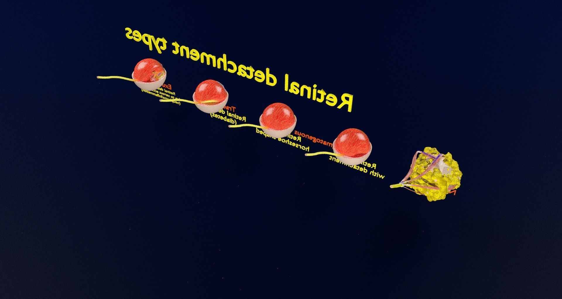 Retinal detachment types eye 3D model_60