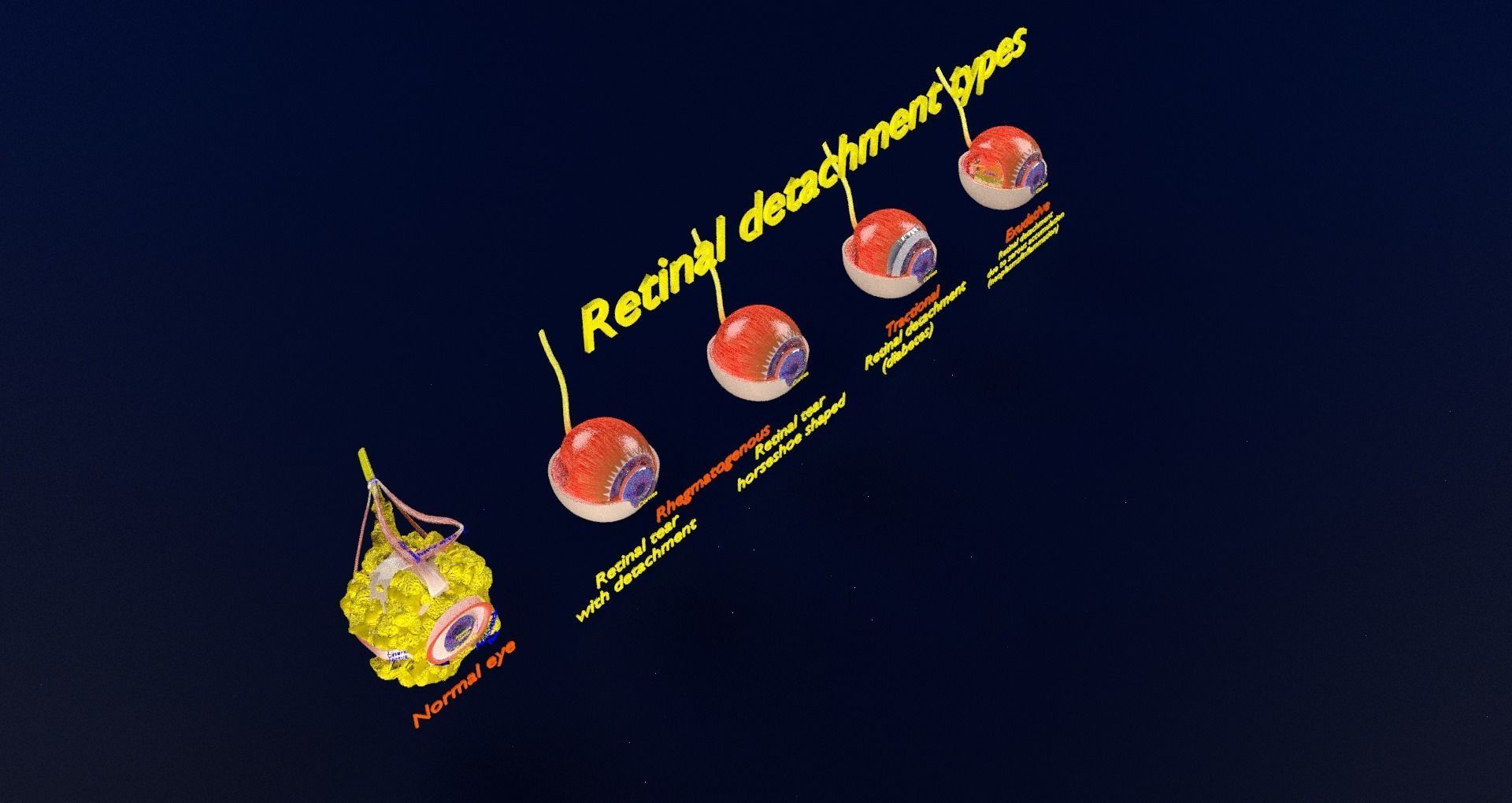 Retinal detachment types eye 3D model_44