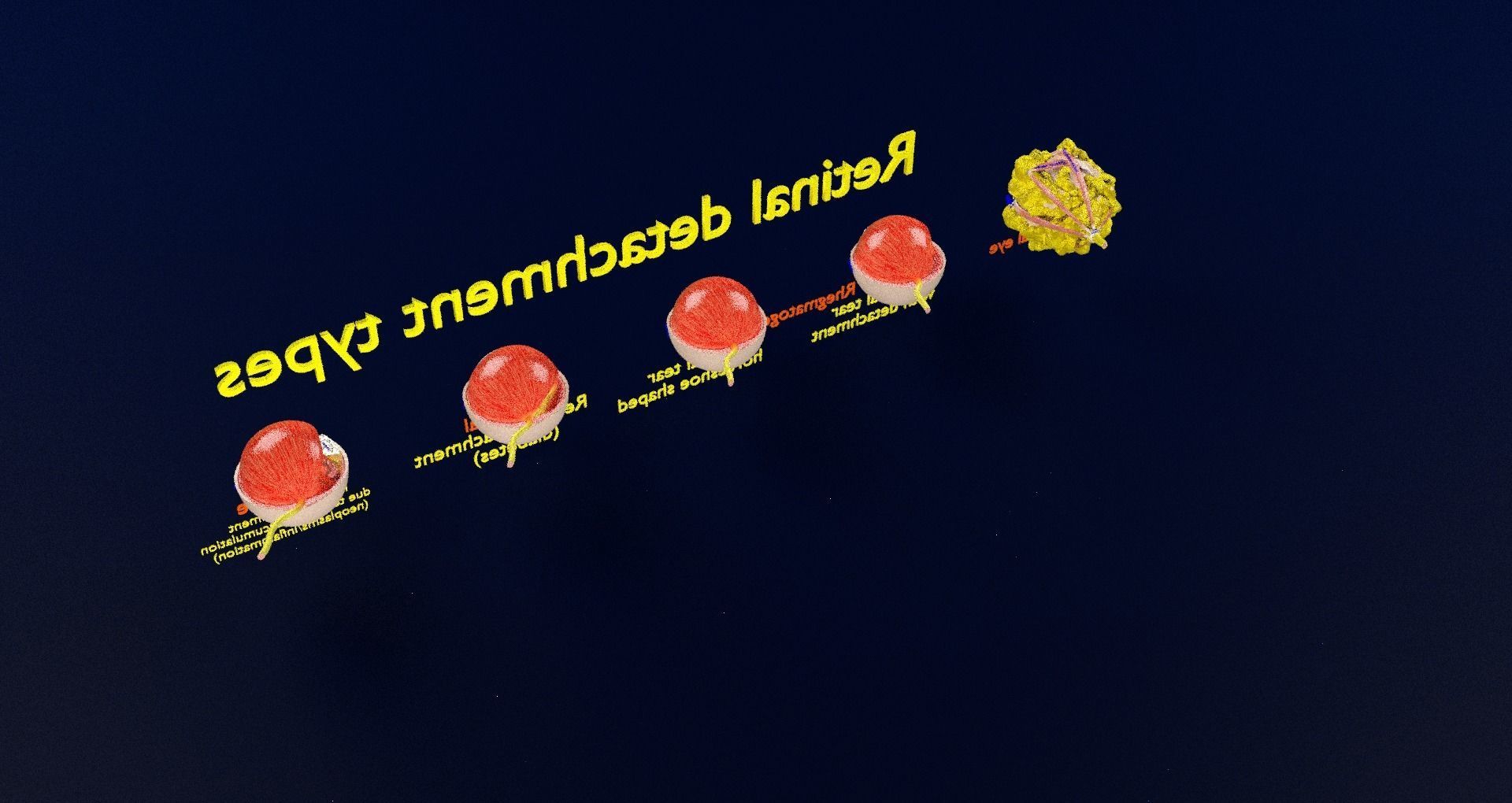 Retinal detachment types eye 3D model_72