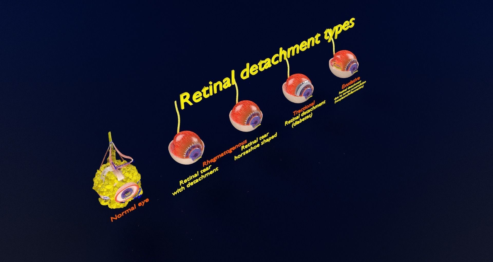 Retinal detachment types eye 3D model_36