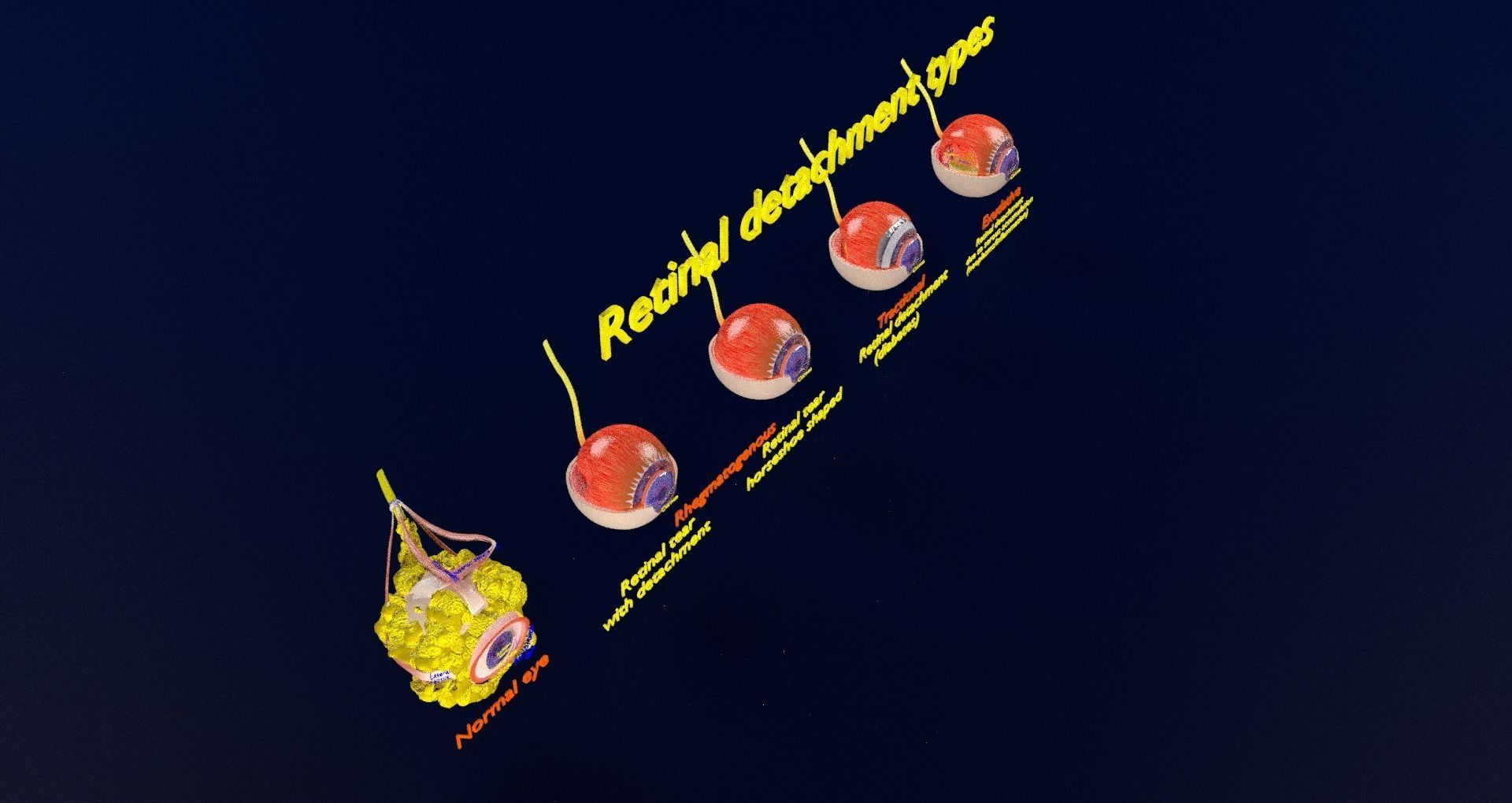 Retinal detachment types eye 3D model_40