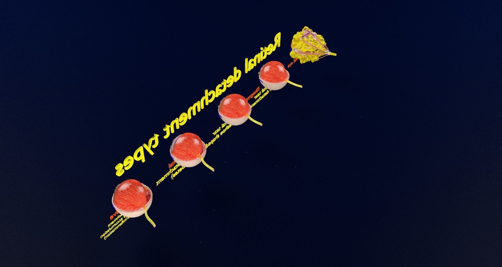 Retinal detachment types eye 3D model_74
