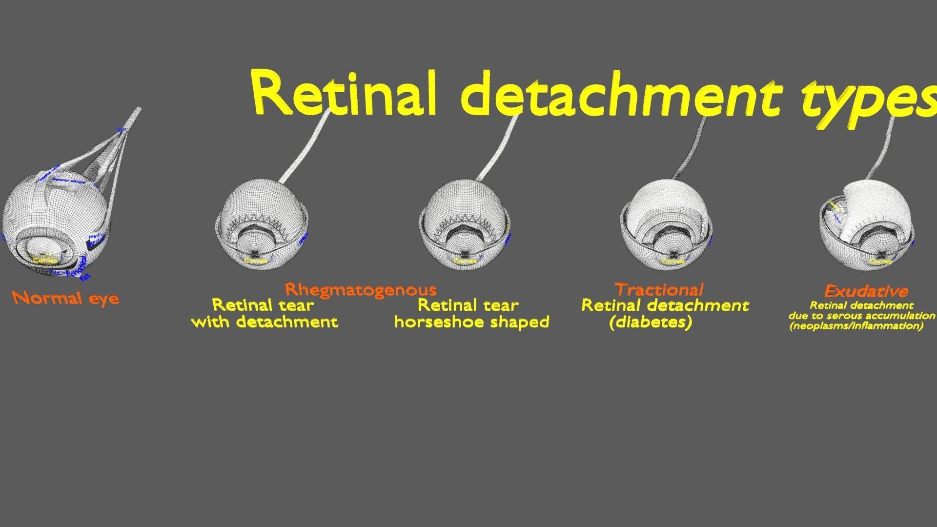 Retinal detachment types eye 3D model_20
