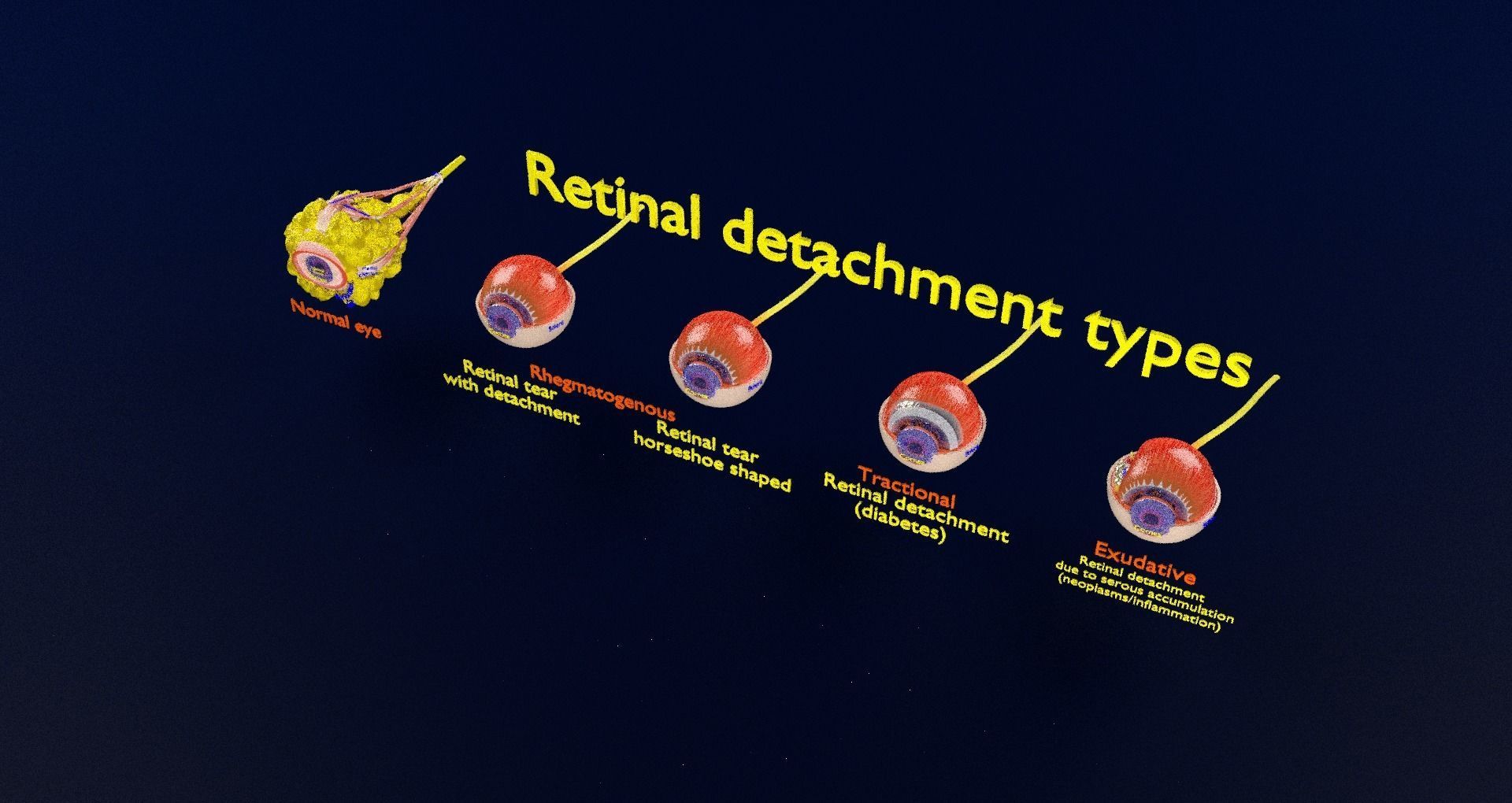 Retinal detachment types eye 3D model_92