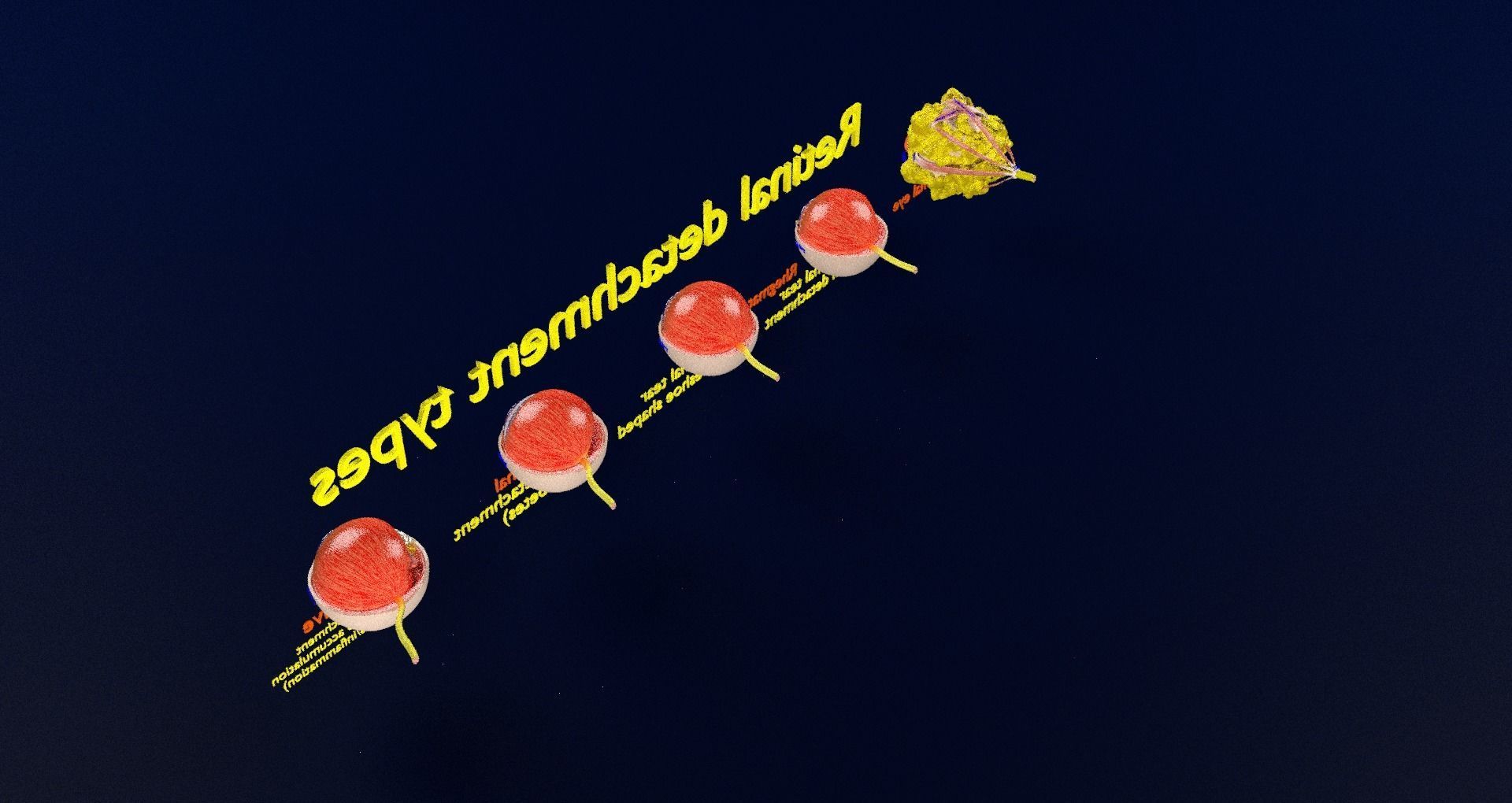 Retinal detachment types eye 3D model_83