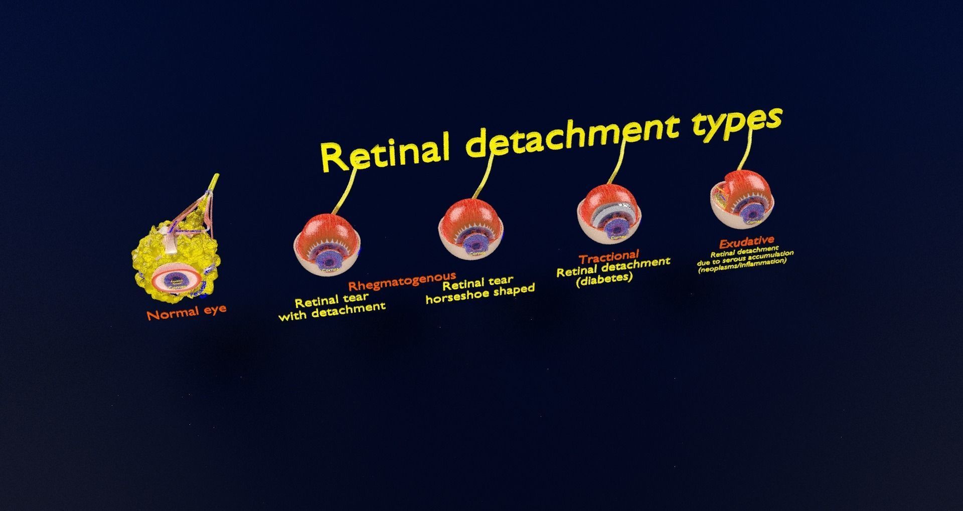 Retinal detachment types eye 3D model_30