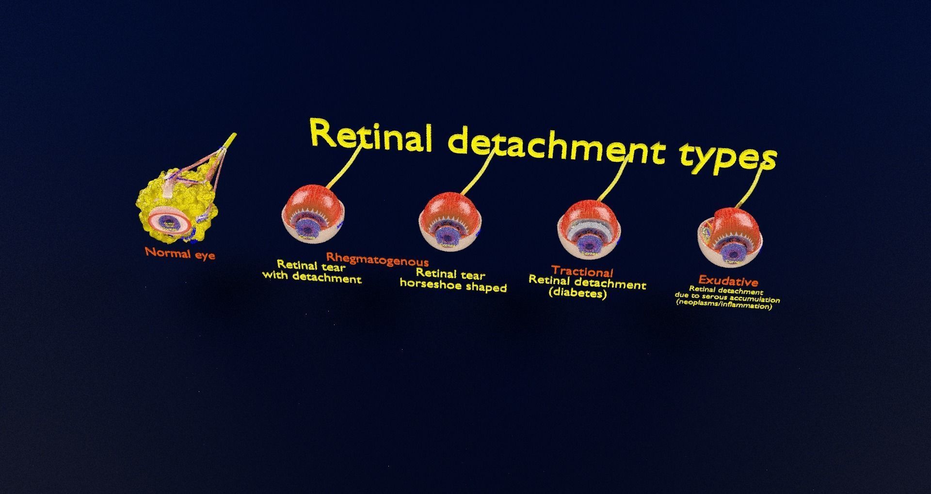 Retinal detachment types eye 3D model_98