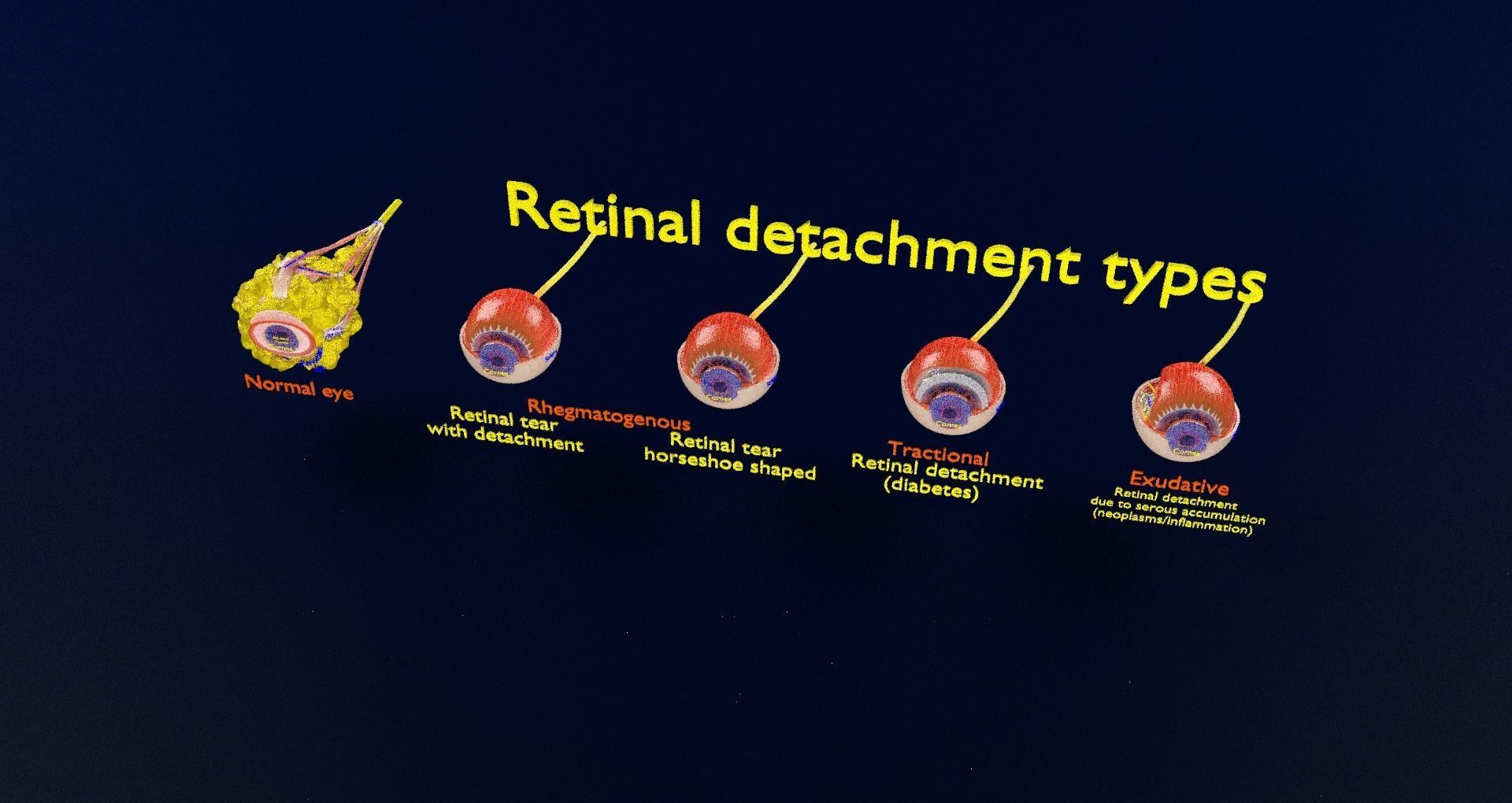 Retinal detachment types eye 3D model_96