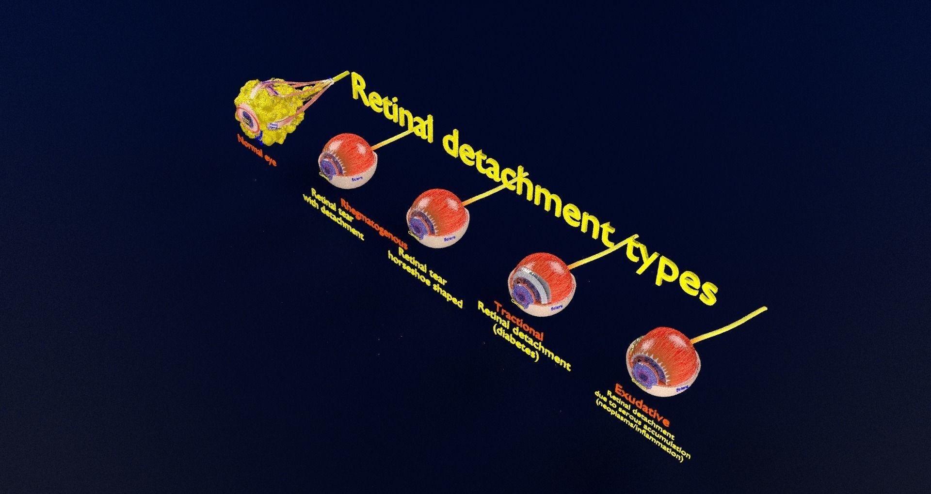 Retinal detachment types eye 3D model_88