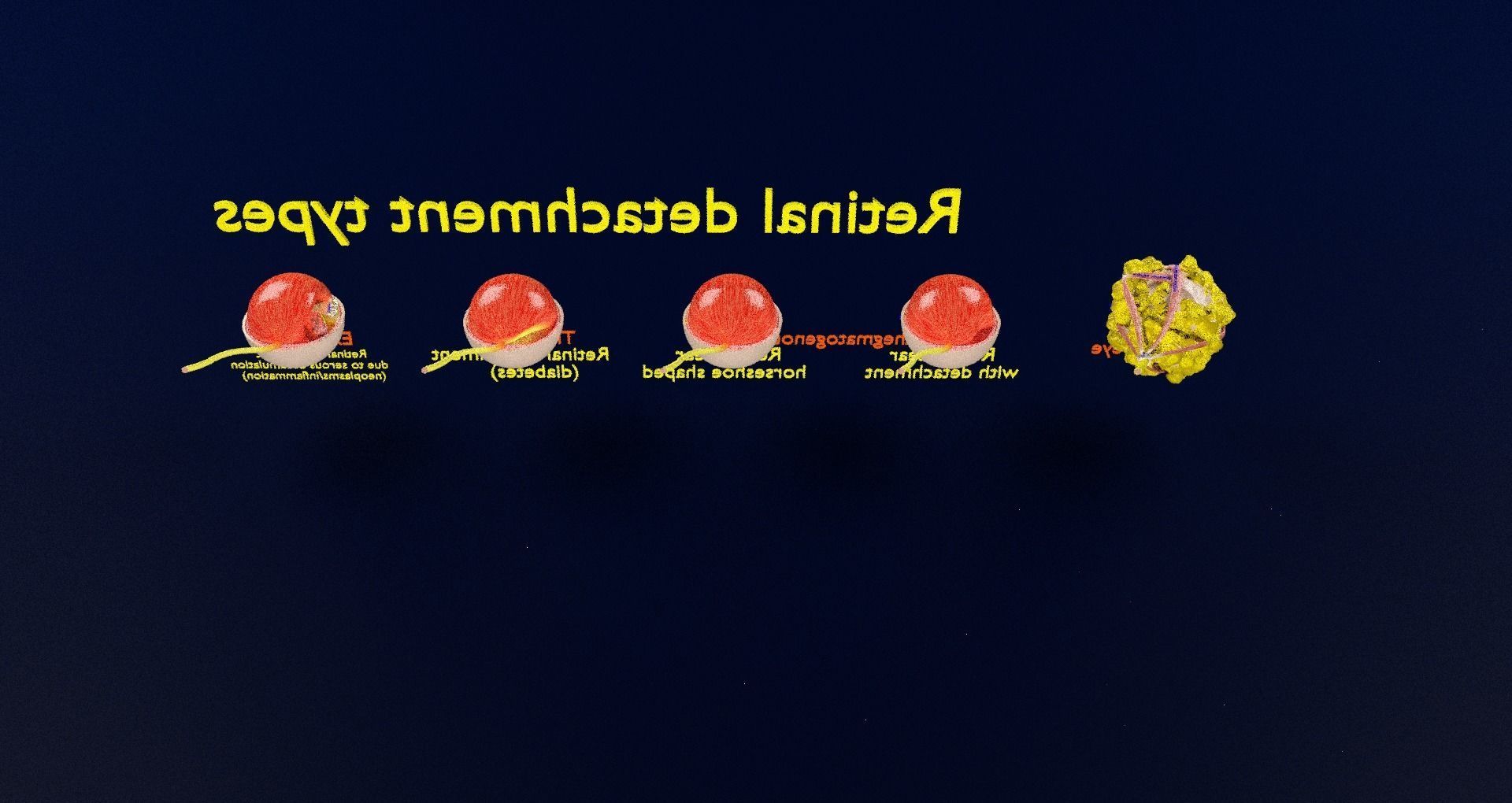 Retinal detachment types eye 3D model_63