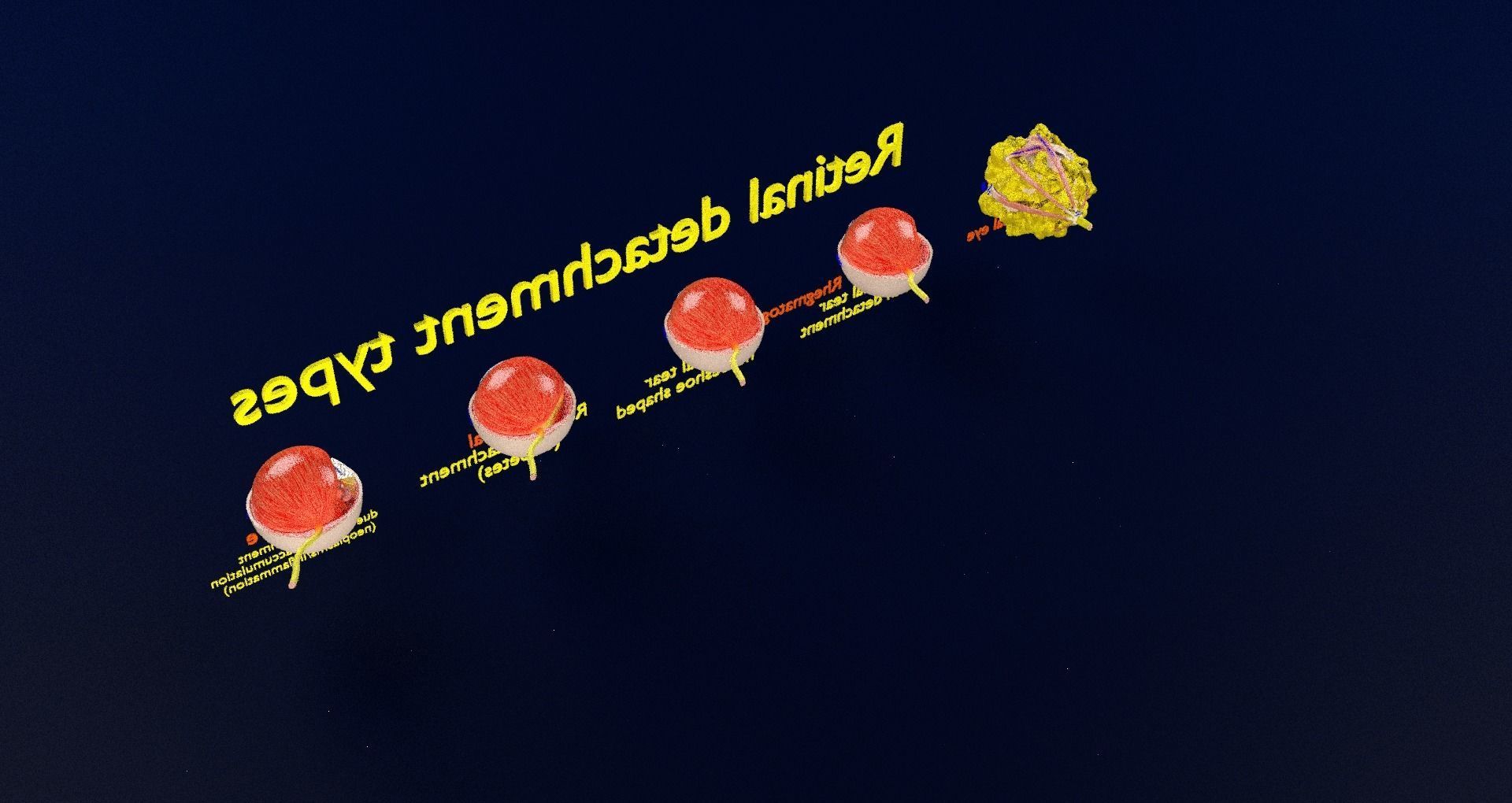 Retinal detachment types eye 3D model_71