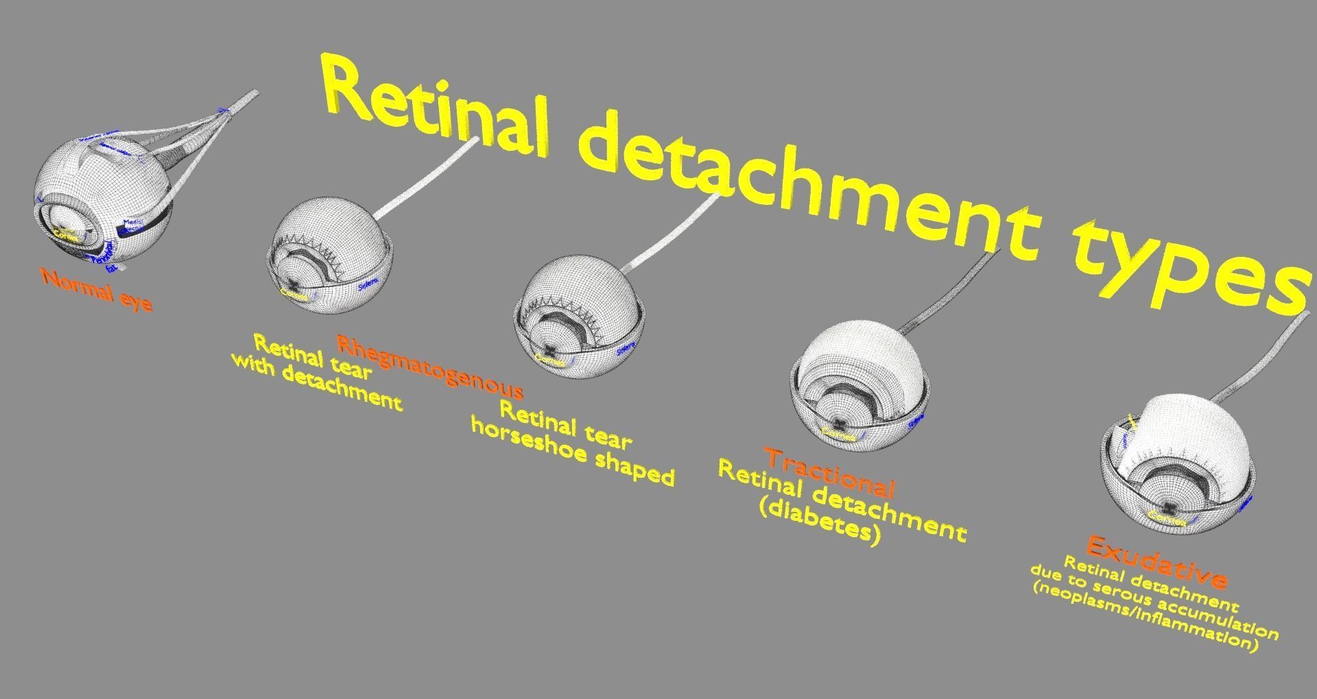 Retinal detachment types eye 3D model_18