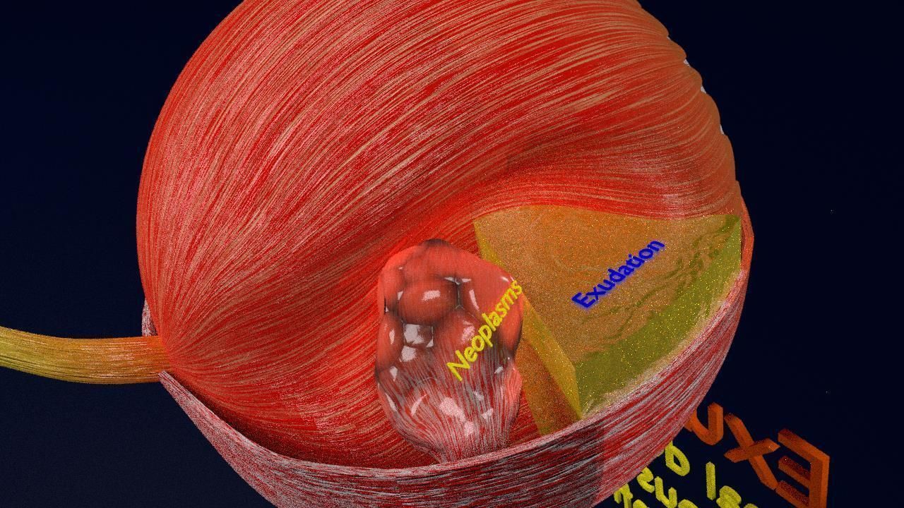 Retinal detachment types eye 3D model | CGTrader