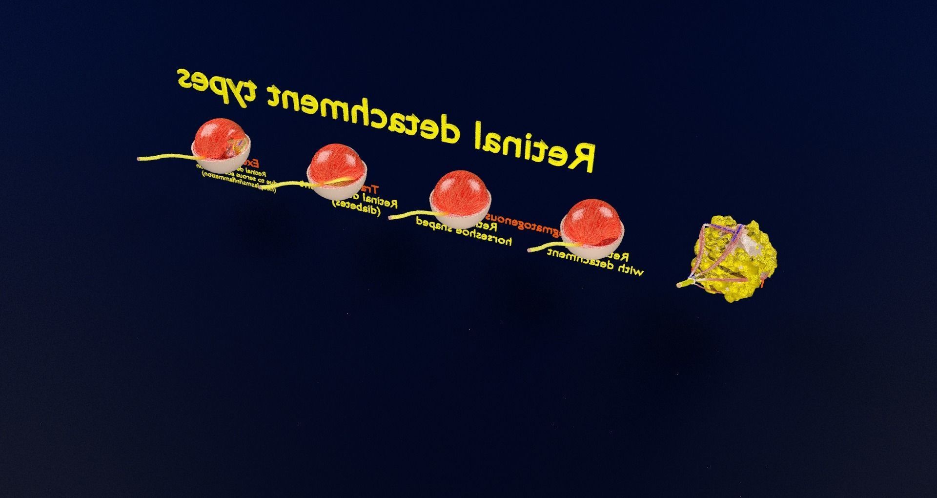 Retinal detachment types eye 3D model_64