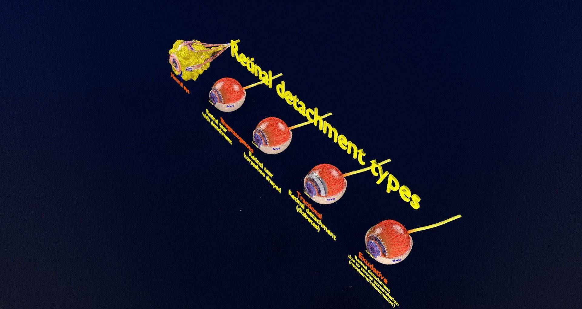 Retinal detachment types eye 3D model_90
