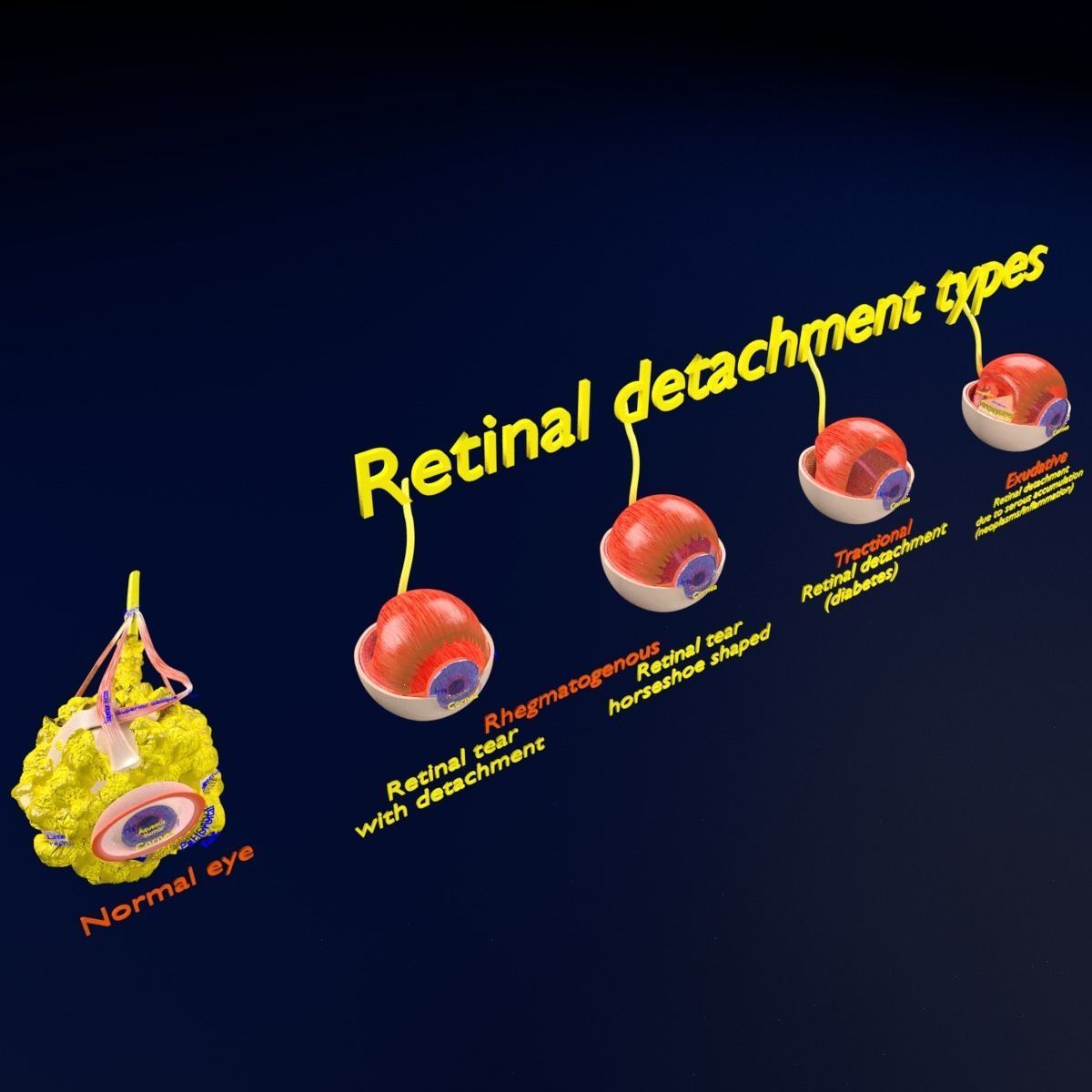 Retinal detachment types eye 3D model_17