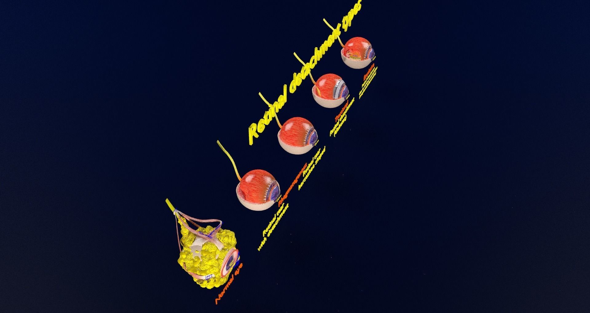 Retinal detachment types eye 3D model_45