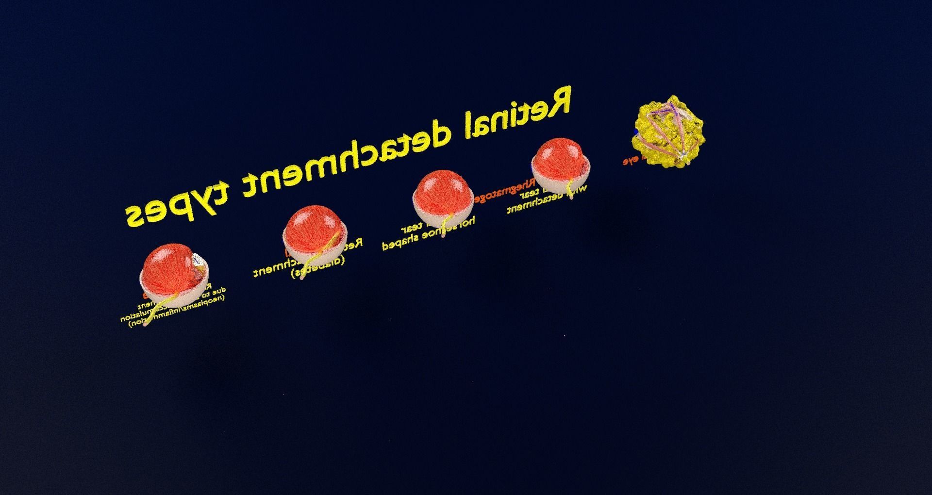 Retinal detachment types eye 3D model_76