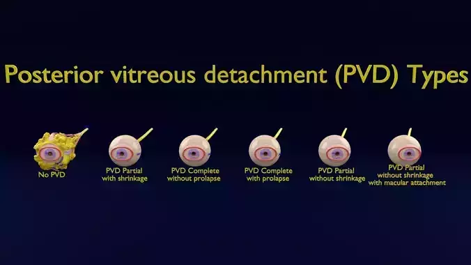 Posterior vitreous detachment types eye 3D model