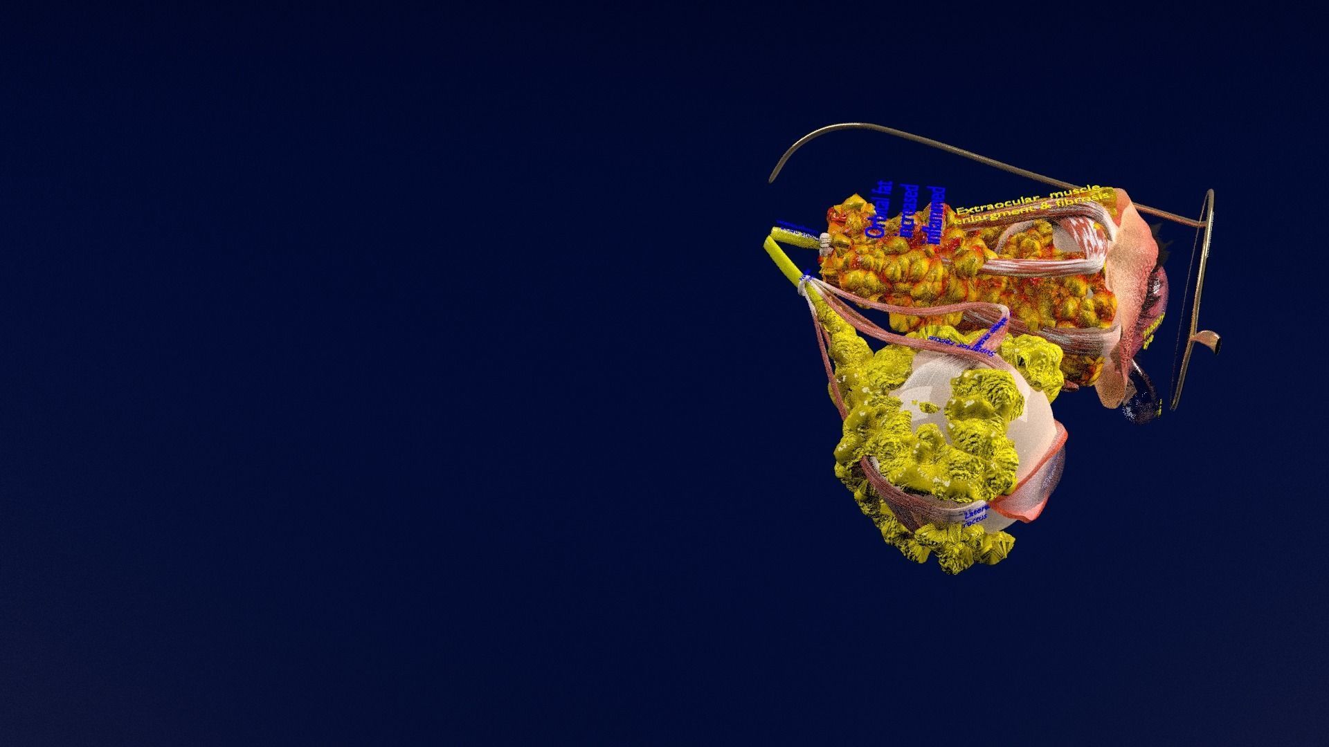 Thyroid eye lesions 3D model_38