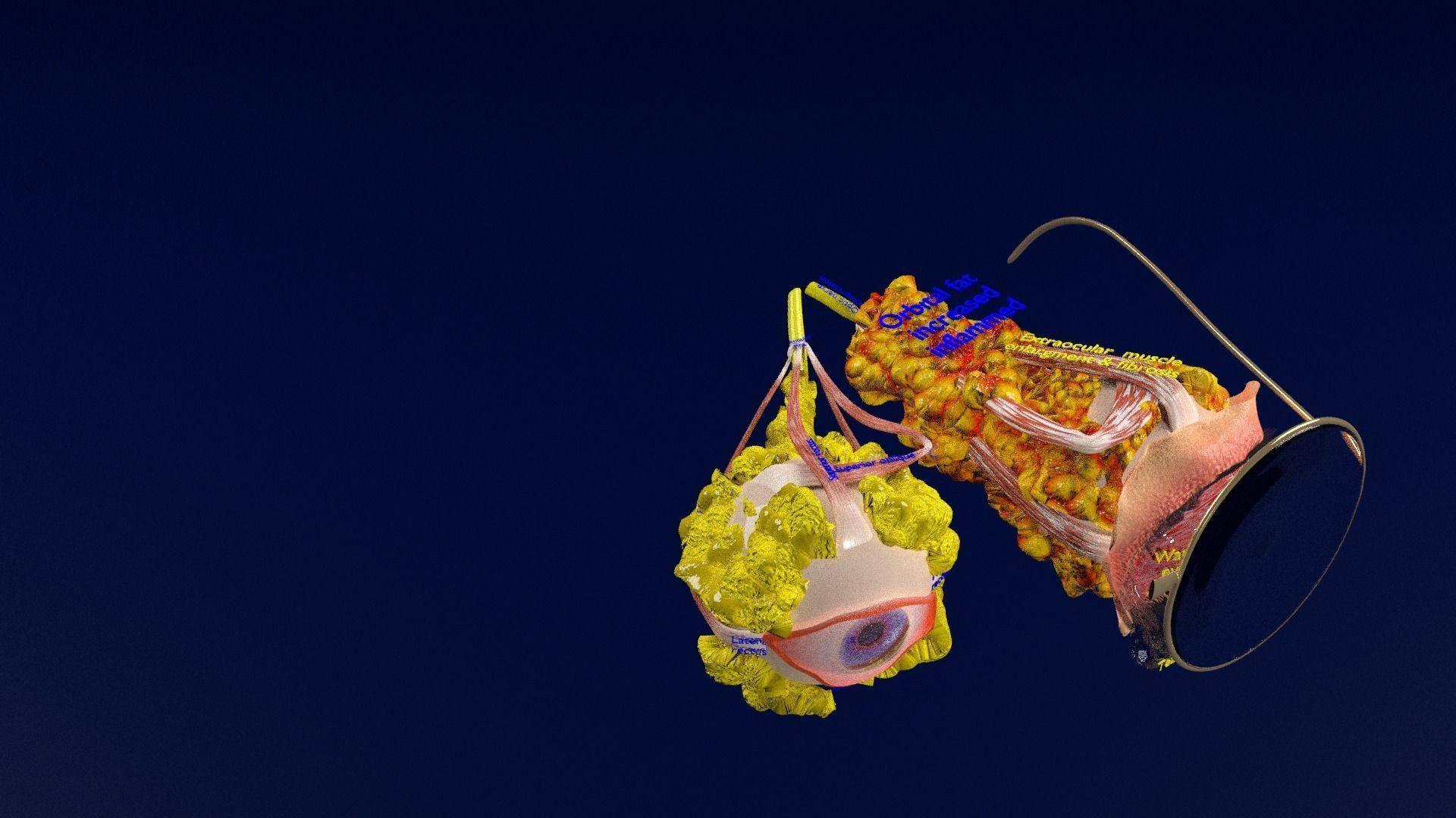 Thyroid eye lesions 3D model_52