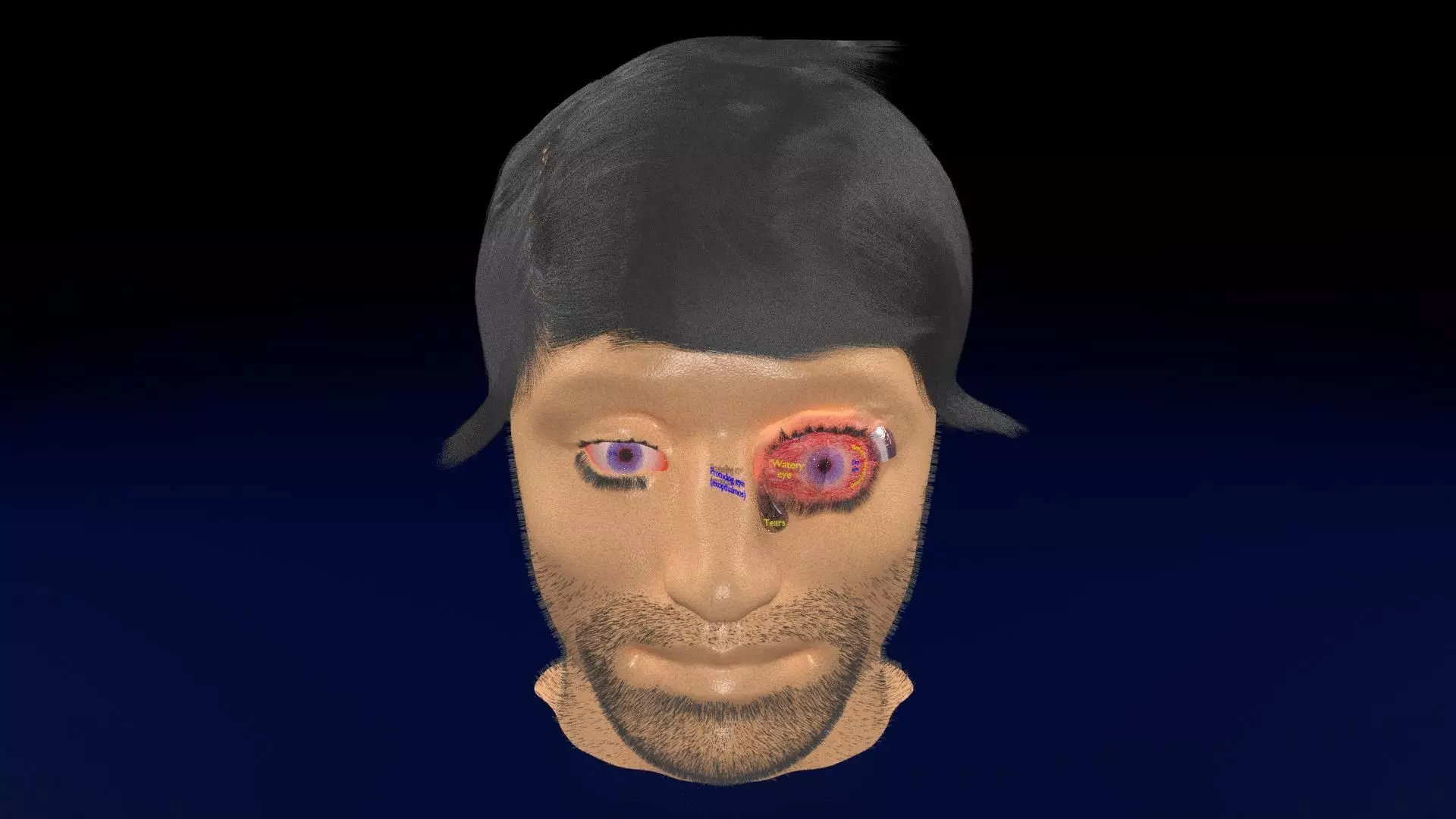 Thyroid eye lesions 3D model_0