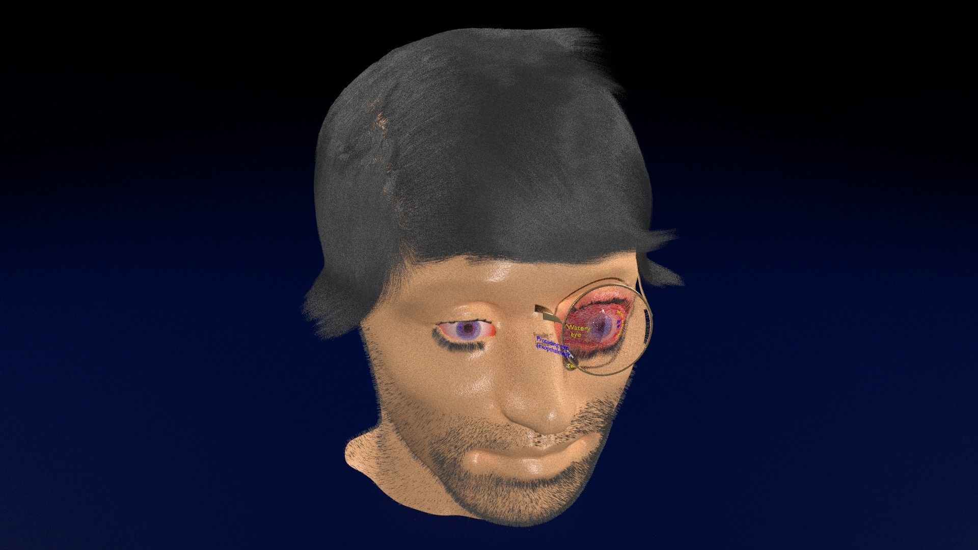 Thyroid eye lesions 3D model_80