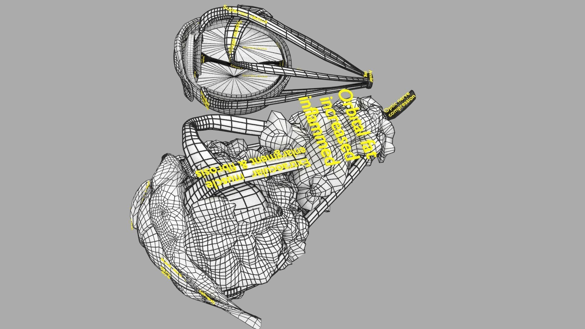 Thyroid eye lesions 3D model_28